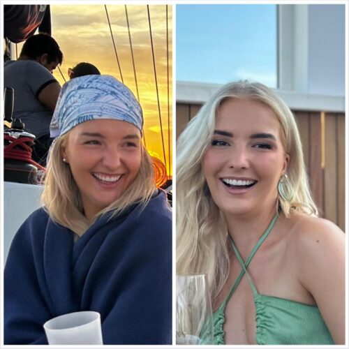 Gummy smile botox