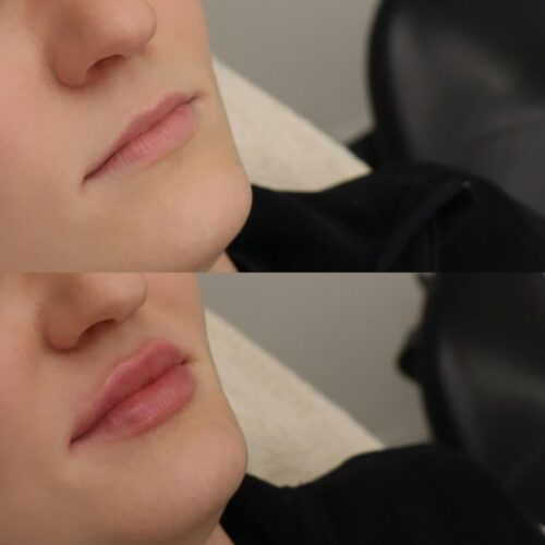 juvederm kokemuksia