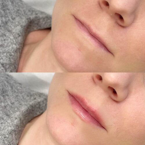 juvederm kokemuksia