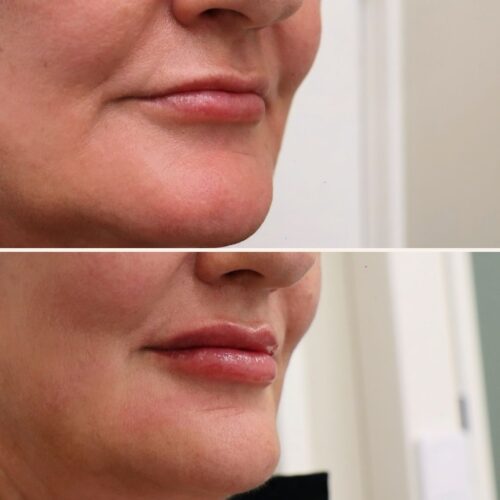 juvederm kokemuksia