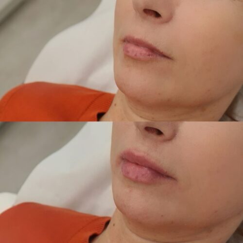 juvederm kokemuksia