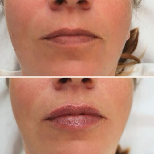juvederm kokemuksia