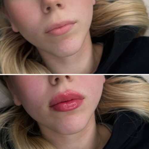 juvederm kokemuksia