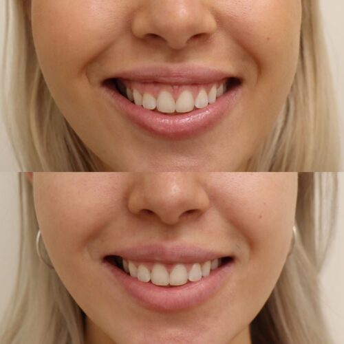 botox helsinki Ienhymy, botuliinihoito Helsinki gummy smile