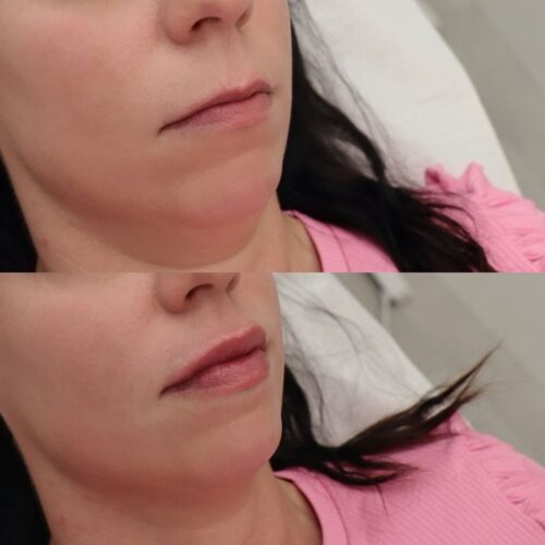 Juvederm 0,5