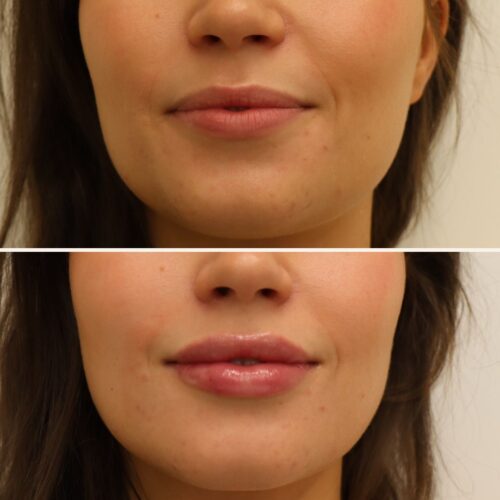 Juvederm huulten täyttö 0,55 ml