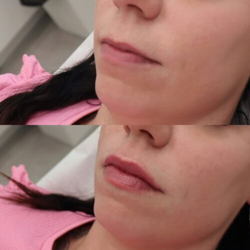 Juvederm kokemuksia 0 5 ml