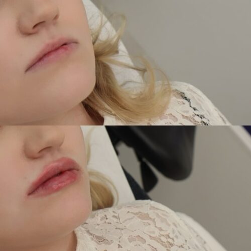 Juvederm kokemuksia sh Ninia Nyman