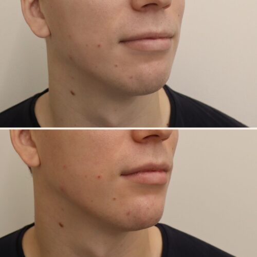Leuan muotoilu juvederm