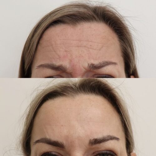 Botox Helsinki, ennen jälkeen botox hinta