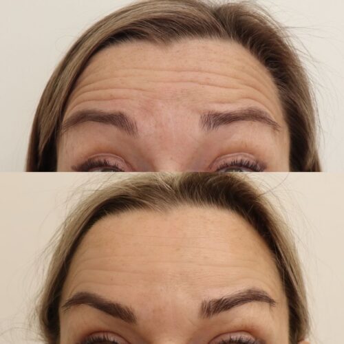 Maltillinen Botox otsaan