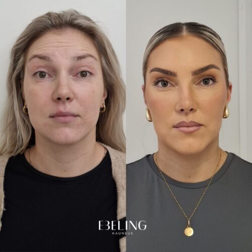 Botox otsaan