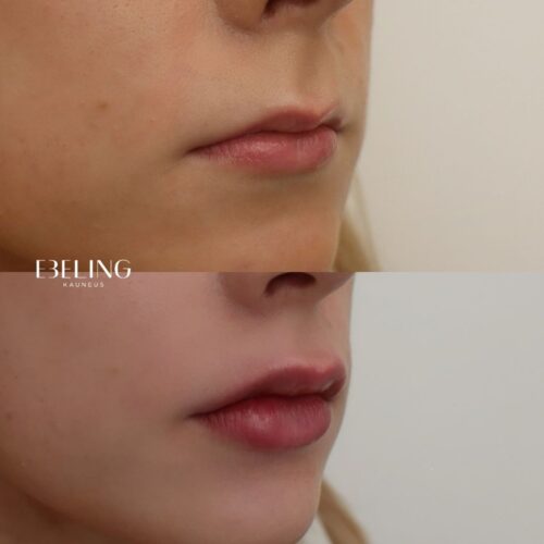 Restylane Kysse Huulten täyttö Emilia Sundqvist Helsinki (2)