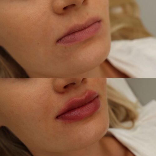 Restylane-huulet 310724_1