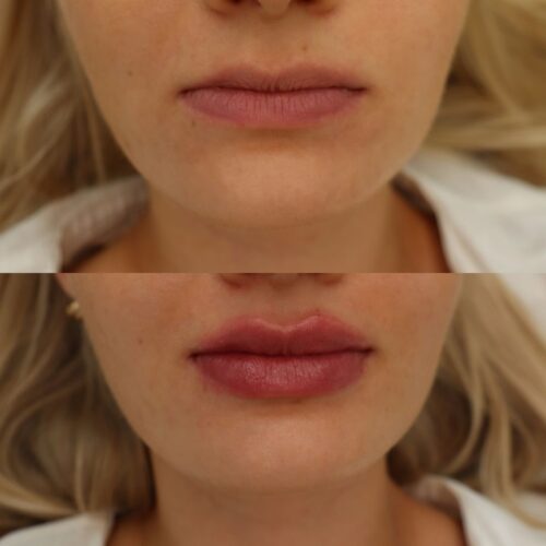 Restylane-huulet_310724_2