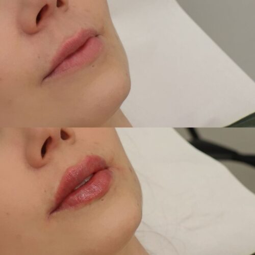 Restylane kokemuksia E-Kauneus