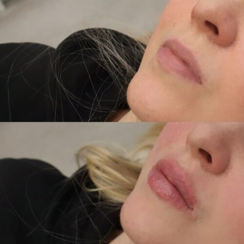 Restylane kokemuksia Ebeling