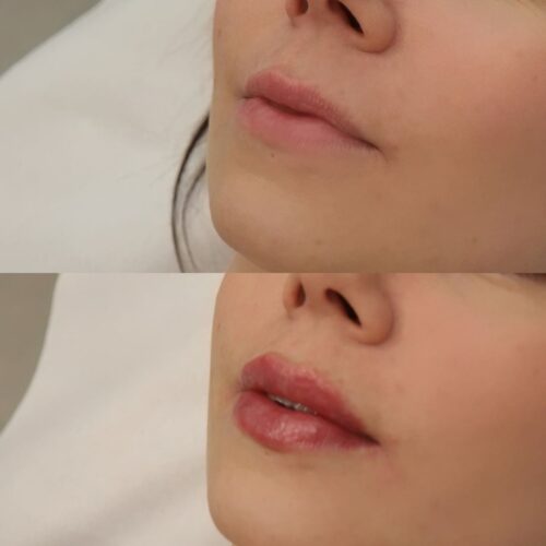 Restylane kokemuksia Ninia Nyman Ebeling