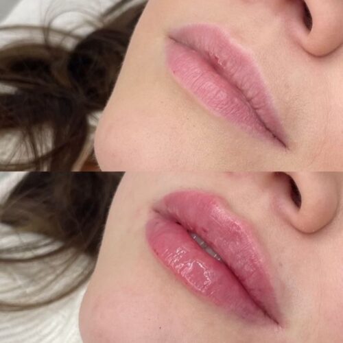 juvederm kokemuksia