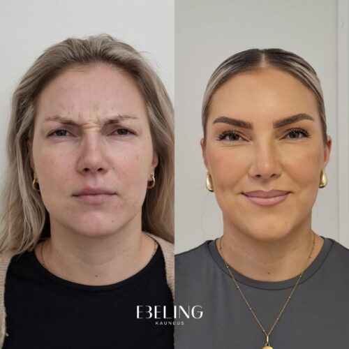 botox helsinki