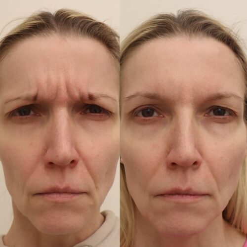 botox helsinki