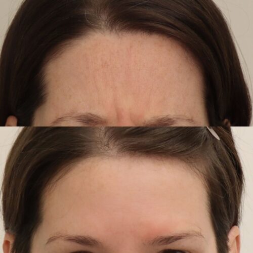 Sibeliusryppy botox Helsinki (2)