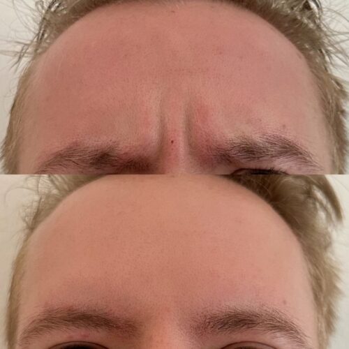 Sibeliusryppy botox Helsinki (3)