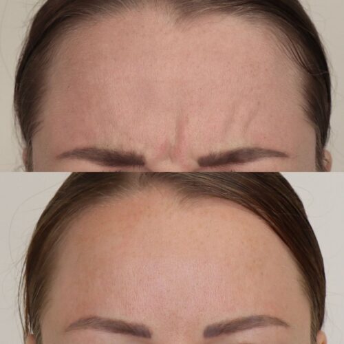 Sibeliusryppy botox Helsinki