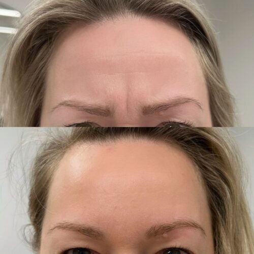 Sibeliusryppy botox hoito