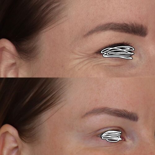 Silmäkulmat botox Helsinki