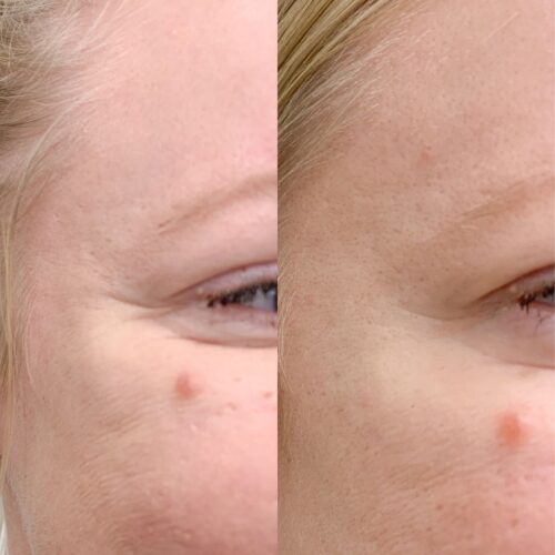 Silmäkulmat botox ennen jälkeen