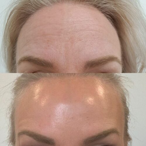 Botox Helsinki, ennen jälkeen botox hinta