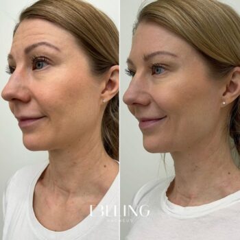 Botox: hinta alk. 249 euroa