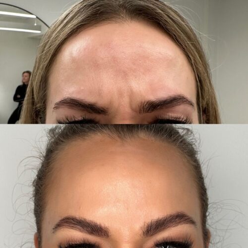 paras botox hoito emilia sundqvist helsinki botox helsinki