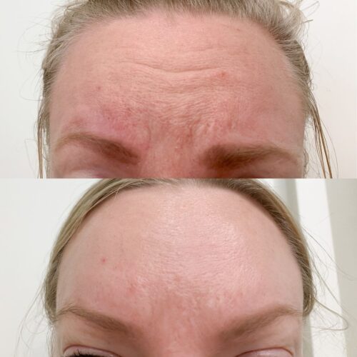 botox luonnollinen