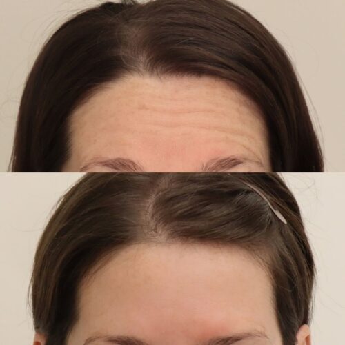 botox otsa