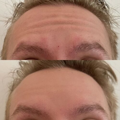 botox otsa (2)