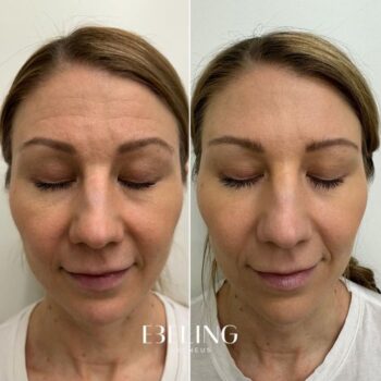 Botox – paras apu ryppyihin