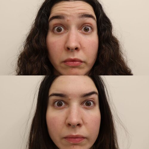 botox otsa