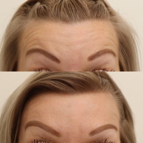 botox otsa, emilia sundqvist (2)
