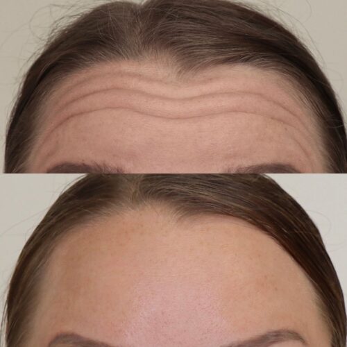 botox otsa, emilia sundqvist