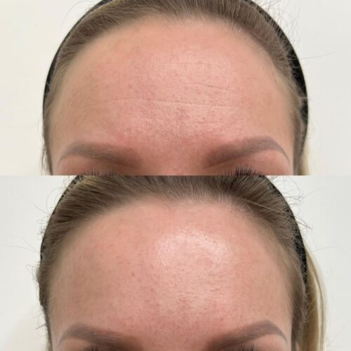 ennen jalkeen baby botox helsinki