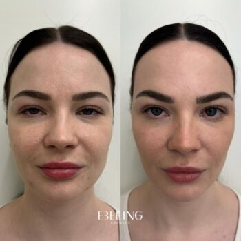Full-face-botox