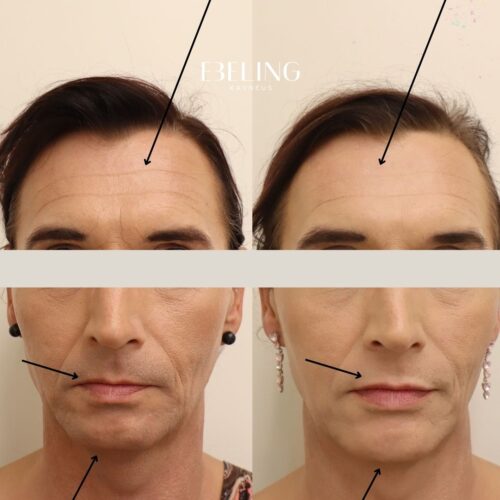 full face tayteainehoito botox helsinki