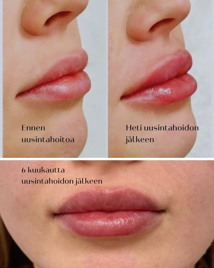 huulitäyte kuinka pitkään tulos kestää