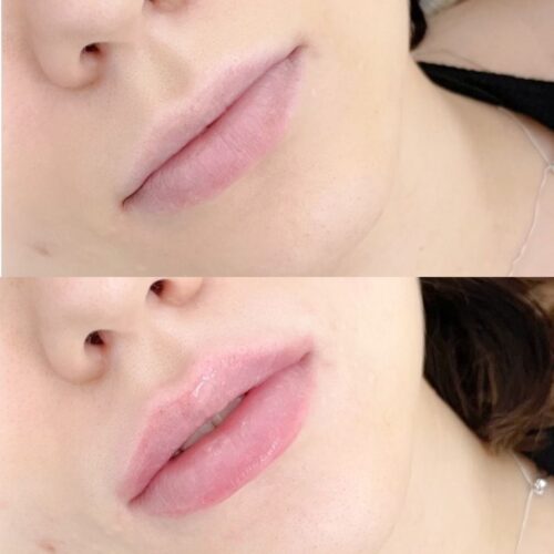 huulten juvederm taytto
