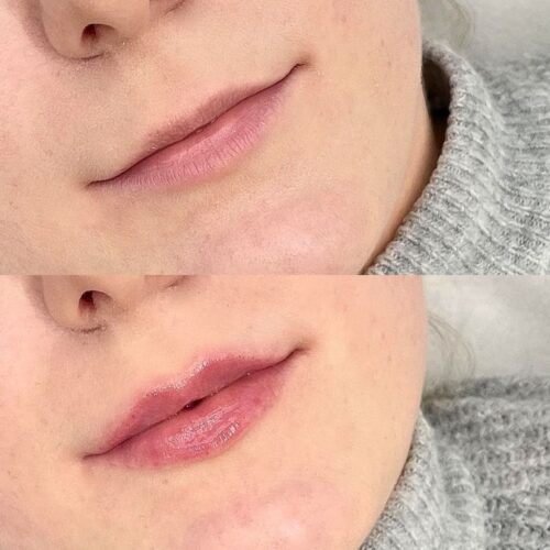 huulten muotoilu juvederm NN Espoo