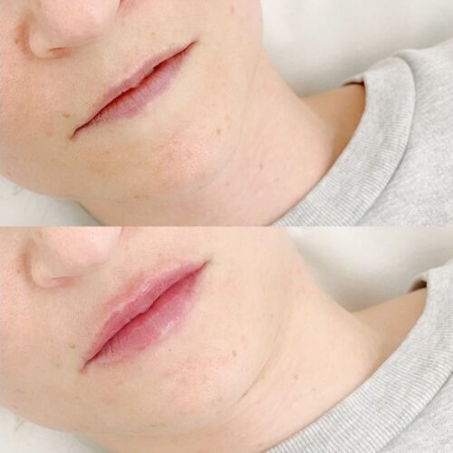 huulten syvakosteutus juvederm volite