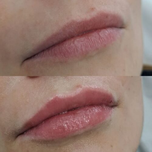 juvederm kokemuksia
