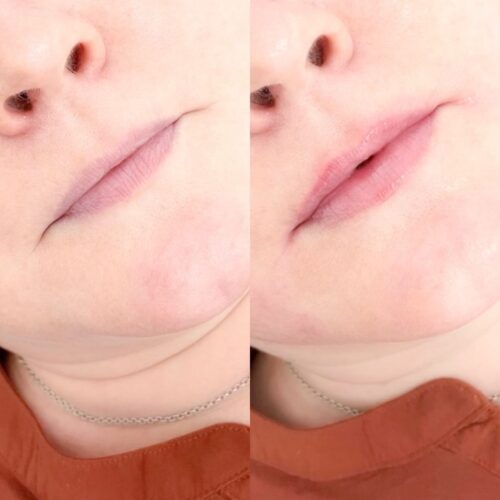 juvederm kokemuksia 0 5 ml (2)